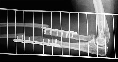 Type P1A fracture—well healed original fracture with NPPIF of both forearm bones distal to the tip of the implant.