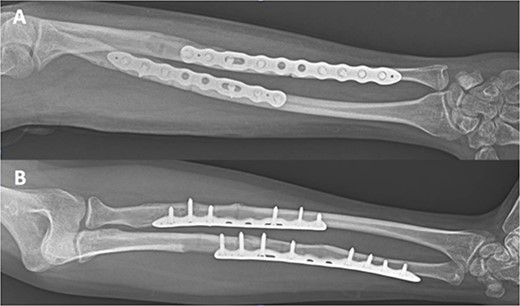Internal fixation of both NPPIFs with a longer plate that bridges the original fracture zone and the new NPPIF. Final follow-up at 36 months after surgery, anterior–posterior X-ray.