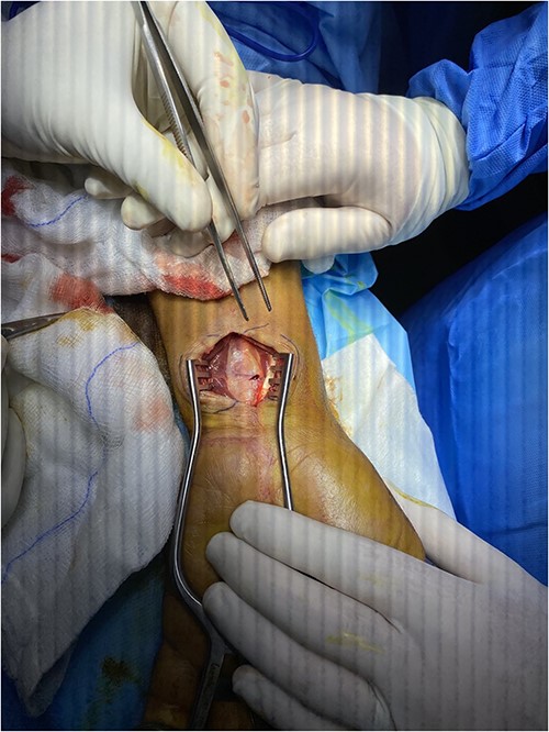 Tenosynovectomy was done under general anesthesia.