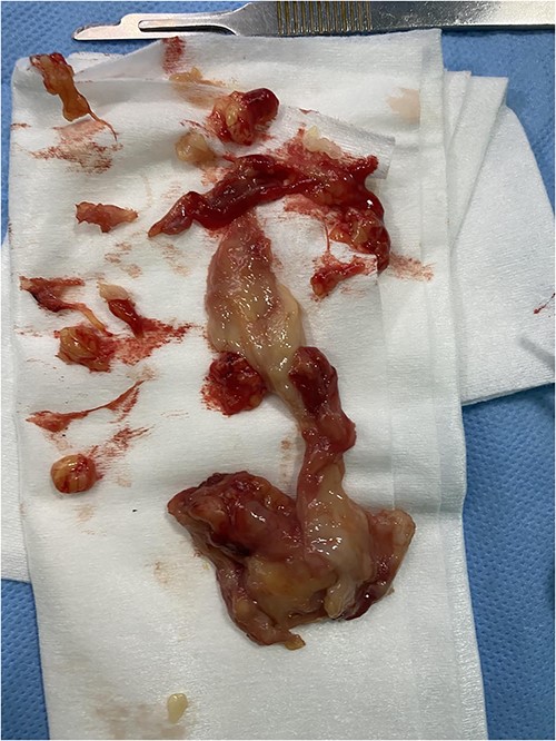 The mass that invaded the median nerve, distal flexor tendons and expansion to metacarpophalangeal joint.