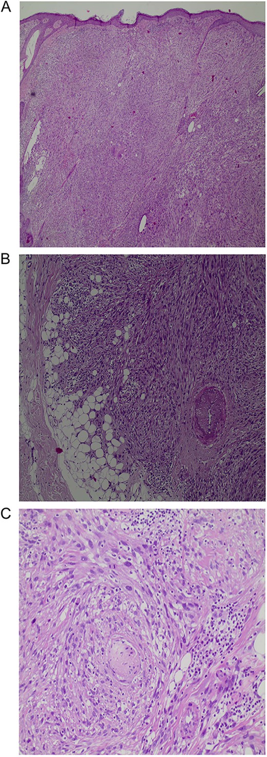 A: An expansile tumor in the dermis (H&E, original magnification X40). B: Involvement of subcutaneous fat (H&E, original magnification X100). C: Perineural invasion (H&E, original magnification X200).