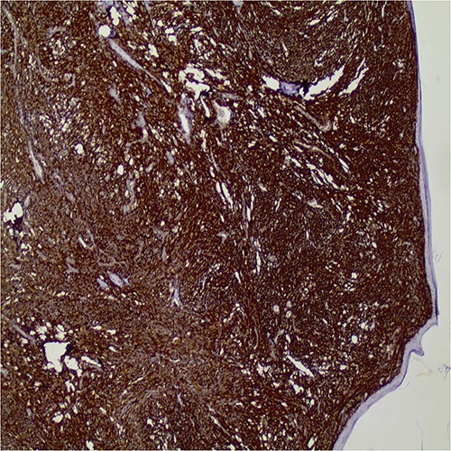 Diffuse CD10 expression by the tumor cells (original magnification X40).