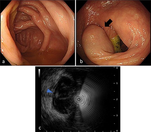 Colonoscopy findings. (a) Total colonoscopy revealing no mucosal changes in the cecum. (b) A tumor suggesting an SMT in the ascending colon (arrow). (c) Endoscopic ultrasonography revealing a cystic lesion (arrowhead) in the ascending colon.