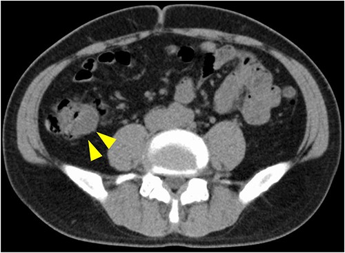 CT image. An iso-density lesion in the ascending colon (arrowhead).