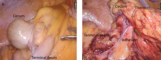 Intraoperative findings. (a) Surgical findings revealing an undetectable appendix in the cecum. (b) After mobilization and resection of the ileoceum, the lesion (arrow) is adhered to the retroperitoneum and the right gonadal vein.