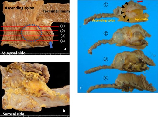 Macroscopic findings. (a) SMT-like elevation in the ascending colon (dotted circle). There are no mucosal changes in the appendiceal orifice (arrow). Each tissue has four slice lines. (b) Fatty tissue adhesion and undetectable appendix are noted on the serosal side of the specimen. (c) Formalin-fixed slices. Slice one shows the appendix surrounded by fatty tissues (arrowhead) and the appendiceal orifice (arrow). Slices two and three primarily show the cut surfaces of the cystic lesion.