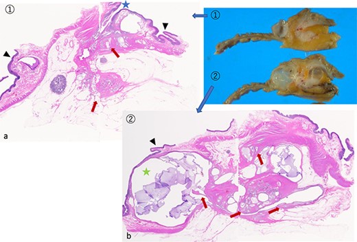 Microscopic findings of the sliced specimen. (a) Cancer cells invading the subserosal layer (arrow) in slice one. The appendiceal orifice (star) and cecal mucosa (arrowhead). (b) Slice two has a cystic lesion (star) with mucus production beneath the colonic mucosa (arrowhead) and cancer invasion (arrow). Note: Springer Nature remains neutral concerning jurisdictional claims in published maps and institutional affiliations.