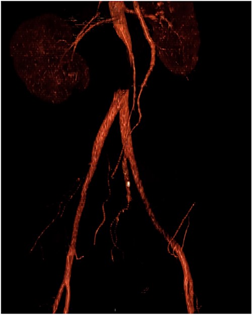 CTA with occlusion of the infrarenal abdominal aorta above the bifurcation of the iliac arteries.