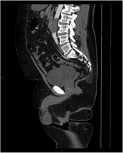 MRI Sagittal with contrast with occlusion of the abdominal aorta.
