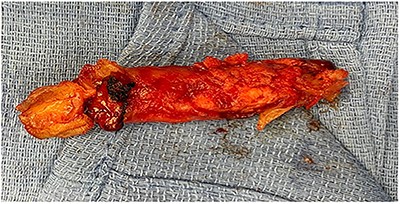 Extracted abdominal aortic thrombus.