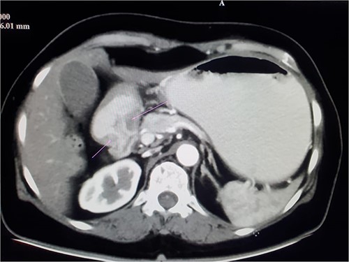 CECT image showing distal gastric cancer.