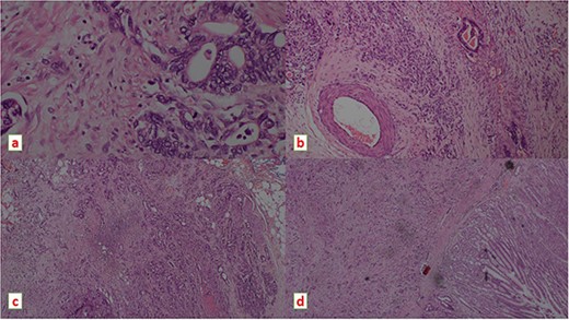Histopathology images showing moderately differentiated adeno carcinoma on H & E stain under light microscope, (a) magnification ×400 (b) ×100 demonstrating a vascular emboli (c) magnification ×100 demonstrating peri neural invasion (d) magnification ×40.