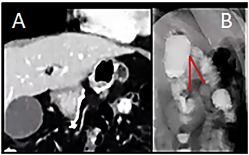 (A) Computed Tomography: Afferent loop bending and gastroenteric anastomotic stenosis. (B) Radiograph showing distal efferent obstruction.