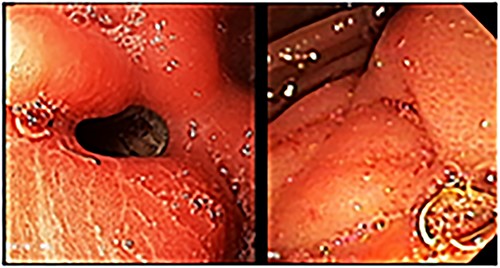 Upper gastrointestinal endoscopy showing gastroenteric anastomotic stenosis.