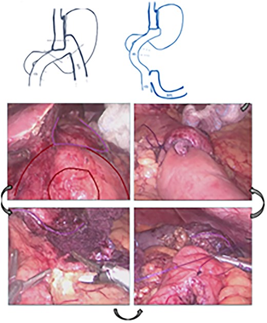 Diagram showing the conversion to Roux-en-Y gastric bypass.