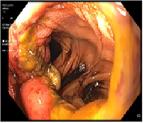 Acute inflammatory changes associated with gastrojejunal anastomosis.