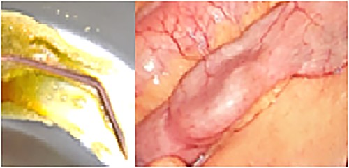 Ascaris lumbricoides extracted from the anastomosis.