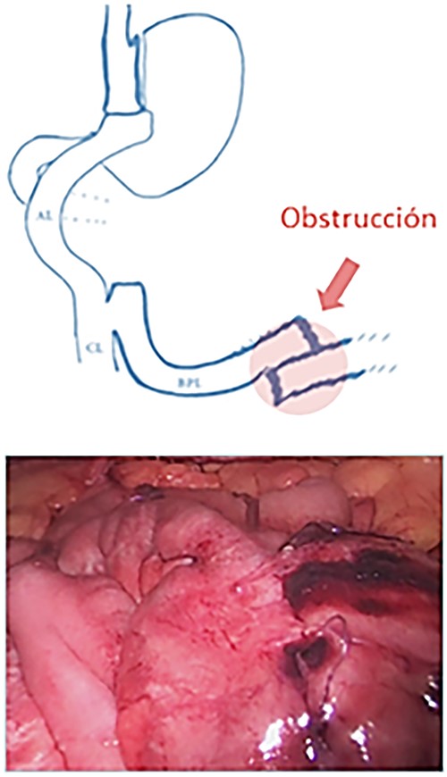 Diagram showing the construction of a new entero-enteric anastomosis.