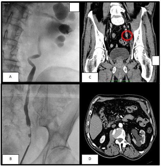 (A, B) The retrograde pyelography, performer before ureteroscopy, showed a minus contrast at the level of the pelvic ureter with an upstream hydroureteronephrosis; (C) left ureteral mass seen at arterious CT-scan; (D) the arterious CT-scan showed a hydronephrosis with corticalization of the calyxes.
