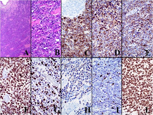 The immunohistochemical panel. The final histological examination showed microscopically a MS with the following immunohistochemistry: CD117 +, myeloperoxidase +, CD99 +, FLI1 +, CD34 +/−, TdT +/−.