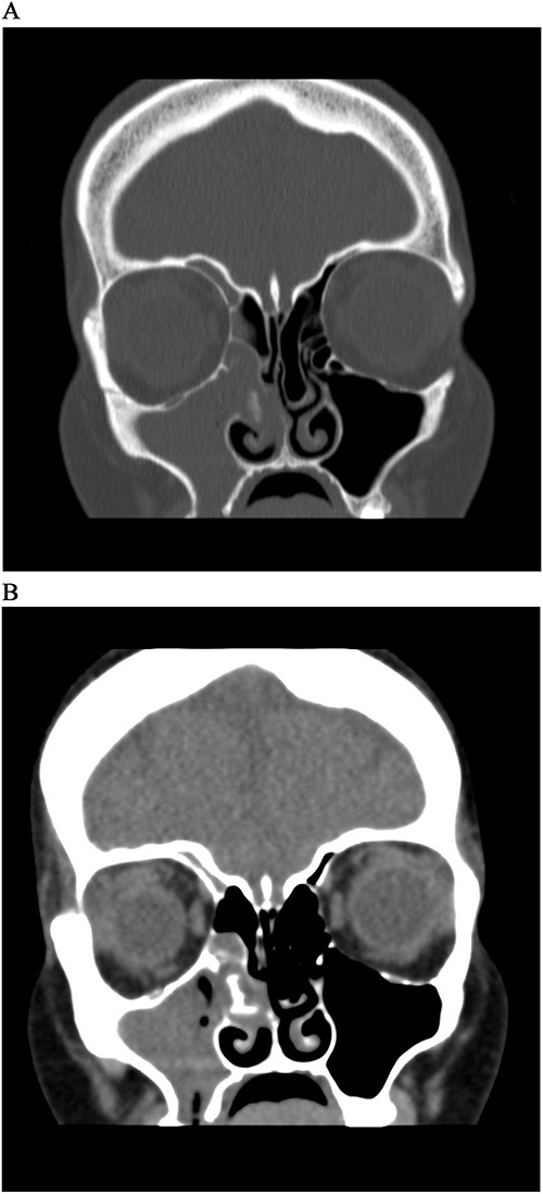 CT Sinus, bone window (A) and soft tissue window (B), coronal cut, shows complete opacification of right maxillary sinus and anterior ethmoidal cells, with a soft tissue mass extending from MM to septum with hyperdensity lesion.