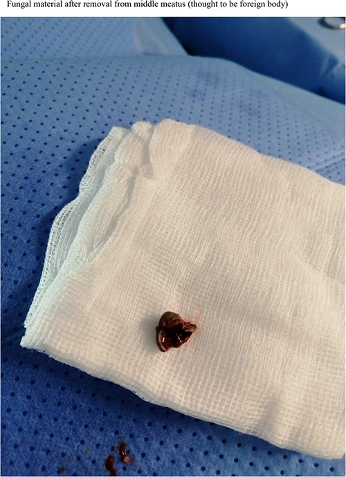 Fungal material after removal from middle meatus (thought to be foreign body).
