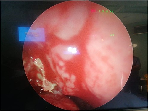 Intra-operative photo shows fungal material with pus discharge in middle meatus.