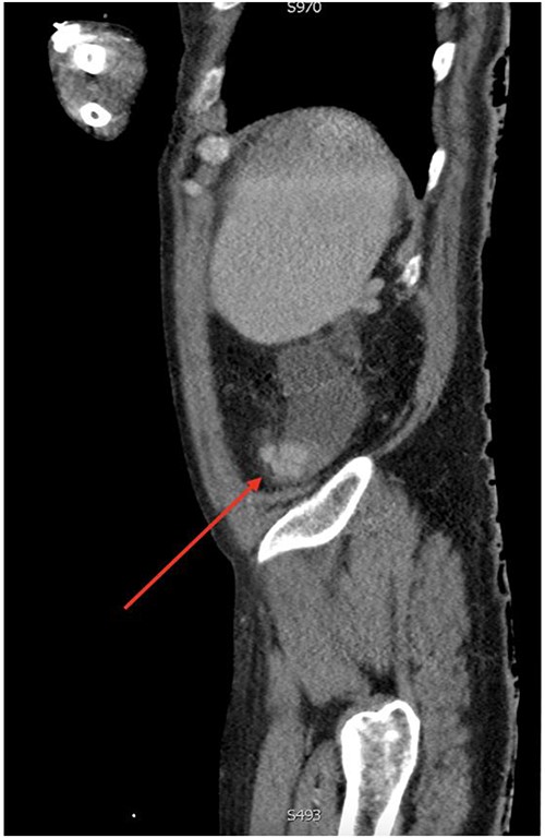 Axial view of computerized tomography imaging in portal venous phase with arrow marking varices at the caecum.
