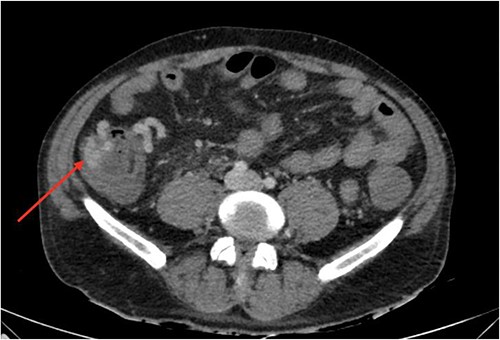 Sagittal view of computerized tomography imaging in portal venous phase with arrow marking varices at the caecum.