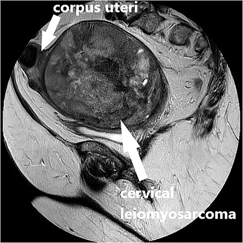 MRI scan, T2-weighted sagittal image of the large vascularized cervical mass in the pelvis with heterogenous and degenerative changes, and corpus uteri on top.