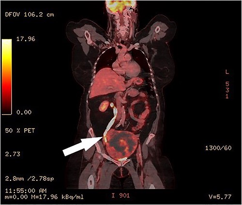PET-CT, coronal image of a dilated right ureter with stenosis at the pelvic mass.