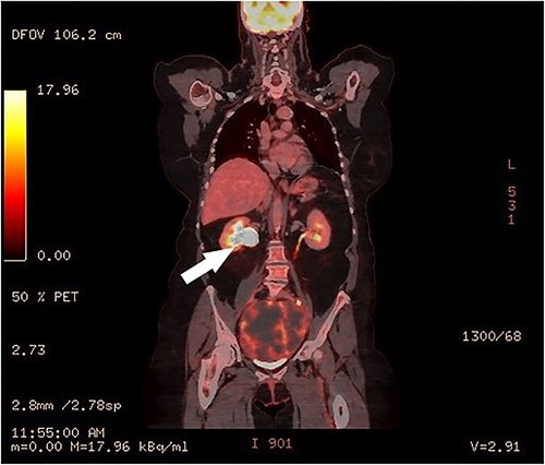 PET-CT, coronal image of the right hydronephrosis.