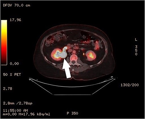 PET-CT, axial image of the right hydronephrosis.