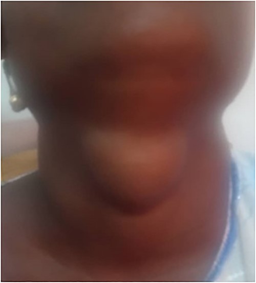 Median sub-hyoid swelling in our patient.