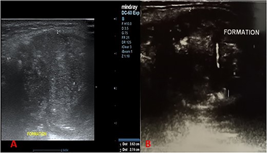 Longitudinal cervical ultrasound sections showing a heterogeneous formation, with more or less regular contours, associated with microcalcifications (A) with liquid portions showing posterior enhancement (B).