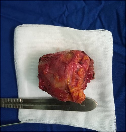 Surgical specimen after Sistrunk procedure.