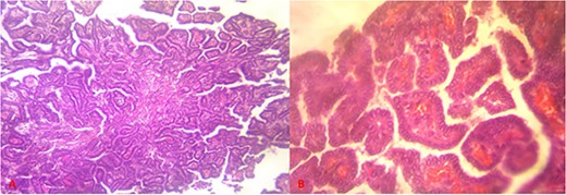 Histological sections showing papillary tumor proliferation ((A) = hematoxylin–eosin staining, magnification ×10), made up of irregularly branched small papillae, lined with cells with clear, vitreous cytoplasm, without true incised nuclei, with edematous, congestive conjunctival-vascular axes ((B) = hematoxylin–eosin staining, magnification ×40).