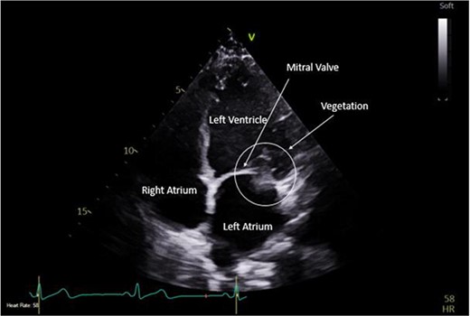 Pre-operative TTE depicting mitral valve with vegetation (labelled).