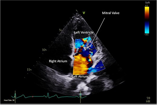 Pre-operative TTE with Doppler depicting mitral valve with vegetation (labelled).