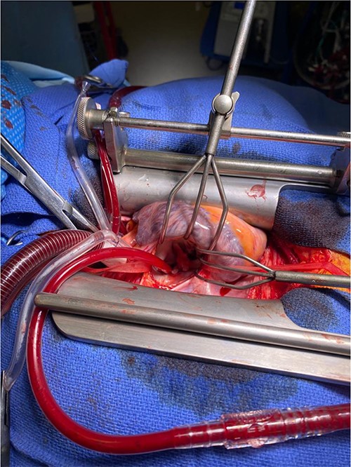 Retracted view of mitral valve with vegetation.