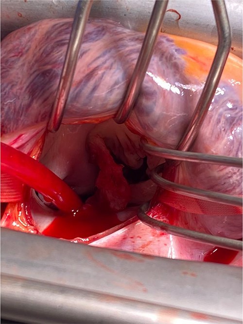 Close-up view of mitral valve with vegetation.