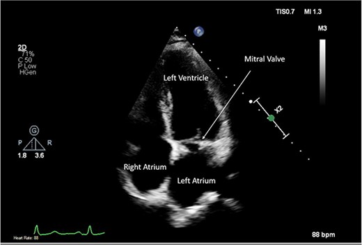 Post-operative TTE depicting mitral valve repair.