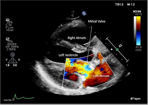 Post-operative TTE with Doppler depicting mitral valve repair.