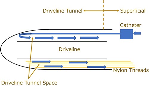 Management concepts and schema of the catheter method via the DLES. A deeply progressed superficial DLI is defined as an infection that has extended from the superficial region of the exit site to the deeper portion but has not reached the pump pocket. An intravenous indwelling catheter can flush the driveline tunnel space from the far end of the space. Notably, excessive injection pressure should be avoided when injecting the cleaning solution into the driveline tunnel space to prevent contaminated fluid from entering the deep part of the space. A cotton swab with 10% silver nitrate solution is used to eliminate infected and contaminated tissues or to enlarge the confined space. Nylon threads help with the continuous drainage, utilizing a capillary action despite the narrow space.