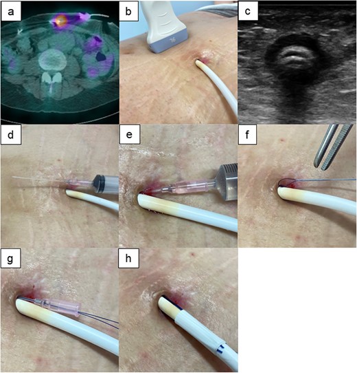 Evaluation of the depth of DLI. (a) Gallium-67 single-photon emission computed tomography (67Ga SPECT) shows the extent of high signalization from the DLES. (b,c) Body surface echography findings show hypoechoic area around the driveline, suggesting effusion of poorly organized inflammatory fluid from the DLES. (d–f) Cleaning of the driveline tunnel using an intravenous indwelling catheter. The catheter is about 5-cm long; it can be cleaned if the length of the infective driveline tunnel is within reach of the cotton swab and intravenous catheter from DLES. (g, h) The intravenous indwelling catheter may be also useful when the nylon threads are inserted into the driveline tunnel space. A catheter and nylon threads are inserted in the driveline tunnel space. Then, the catheter is removed while leaving the nylon threads. SPECT: single-photon emission computed tomography.