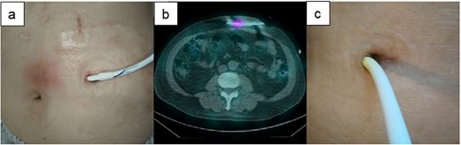 The clinical course of development of the DLI in Case 1. (a) There was some distance between the DLES and the spot with redness and induration. (b) 67Ga SPECT shows high signalization within reach of the cotton swab and intravenous catheter from DLES. (c) The spot with redness and induration healed after treatment with this catheter method.