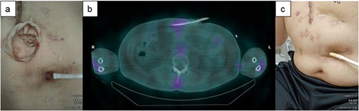 The clinical course of recurrence of the DLI in Case 2. (a) The DLES had erythema and induration. (b) 67Ga SPECT showed an inflammation area localized to 5 cm around the DLES. (c) Purulent discharge was decreased, and the space around the driveline was reduced.