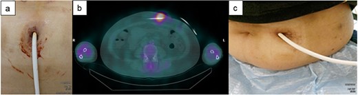 The clinical course of development of the DLI in Case 3. (a) Skin induration and tenderness along the driveline tunnel and bleeding and purulent discharge from the driveline tunnel space were found. (b) 67Ga SPECT suggested a high signal up to 5 cm inside the DLES. (c) The exuded solution became clear, and the amount gradually decreased. The patient’s DLI gradually improved.