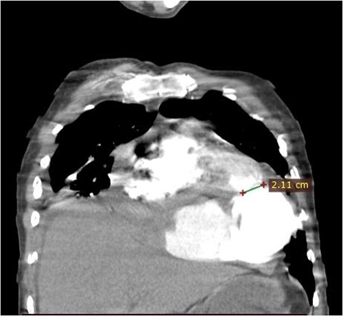 Coronal CT scan image. The figure shows a 2.1 cm communication between left ventricle and pseudoaneurysm. The heart is pushed upwards.