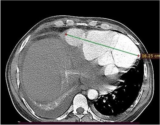 Axial image, just below the lower level of the heart, shows a 16 cm septated pseudoaneurysm that enhances with contrast.